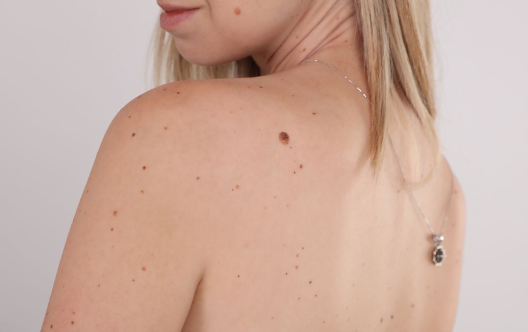 How Do Mole, Cyst, Wart, and Skin Tag Removal Differ from Each Other